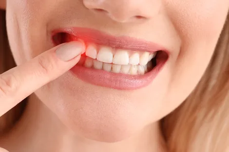 Periodoncia